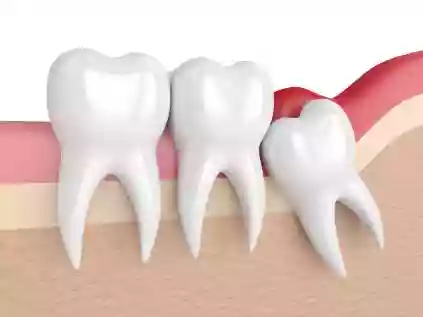 Dente siso: o que é, quando tirar e mais