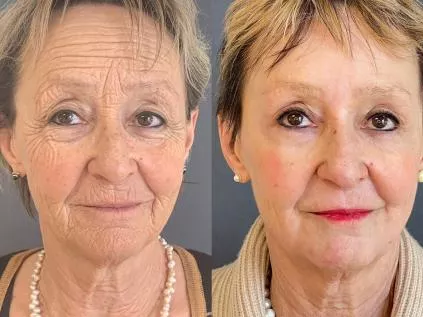 Peeling de Fenol - Antes e Depois: O Que Esperar Dessa Transformação na Pele