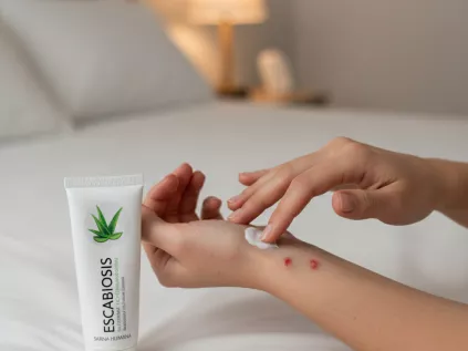 Pessoa aplicando creme calmante na pele com sinais de sarna humana (escabiose) no pulso, em um ambiente de quarto.