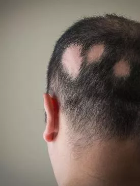 Alopecia Areata: O que é, Causas e Minha Jornada Real
