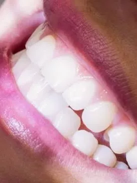 Sonhar com dente caindo: significado, angústia e o que aprendi