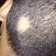 Alopecia Areata