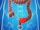 Câncer de Intestino: Identificando os Sinais Precoces